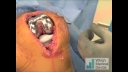 Triathlon Knee Arthroplasty